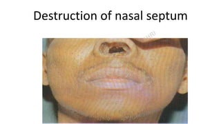 Destruction of nasal septum
 