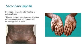 Secondary Syphilis
Develops 4–8 weeks after healing of
primary lesion
Skin and mucous membranes -Usually w
diffuse non-pruritic, indurated rash,
including palms & soles.
 