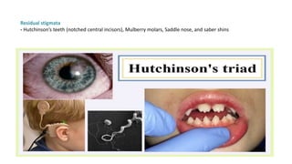 Residual stigmata
- Hutchinson’s teeth (notched central incisors), Mulberry molars, Saddle nose, and saber shins
 