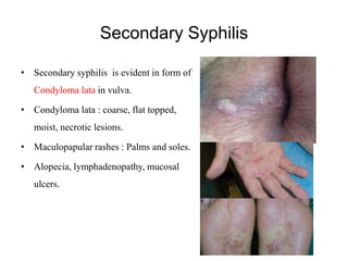 Syphilis Condyloma Latum