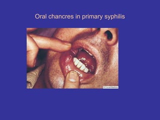 Oral chancres in primary syphilis
 
