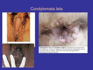 Condylomata lata
 