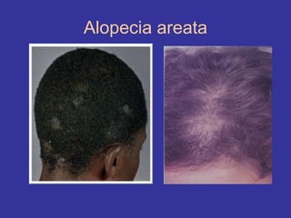 Alopecia areata
 