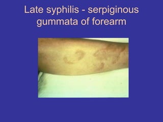 Late syphilis - serpiginous
gummata of forearm
 