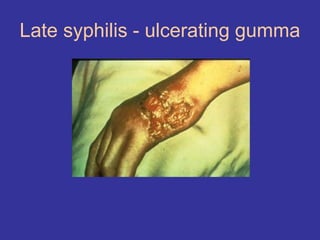 Late syphilis - ulcerating gumma
 