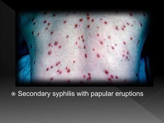  Secondary syphilis with papular eruptions
 