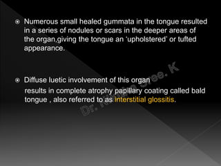  Numerous small healed gummata in the tongue resulted
in a series of nodules or scars in the deeper areas of
the organ,giving the tongue an ‘upholstered’ or tufted
appearance.
 Diffuse luetic involvement of this organ
results in complete atrophy papillary coating called bald
tongue , also referred to as interstitial glossitis.
 