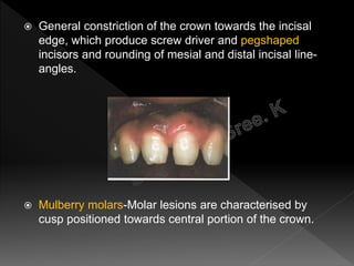  General constriction of the crown towards the incisal
edge, which produce screw driver and pegshaped
incisors and rounding of mesial and distal incisal line-
angles.
 Mulberry molars-Molar lesions are characterised by
cusp positioned towards central portion of the crown.
 