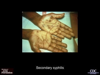 Secondary syphilis
 