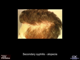 Secondary syphilis - alopecia