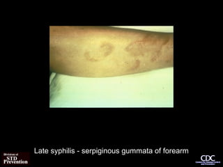 Late syphilis - serpiginous gummata of forearm