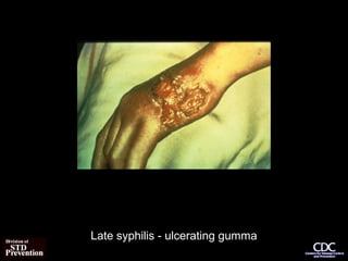 Late syphilis - ulcerating gumma