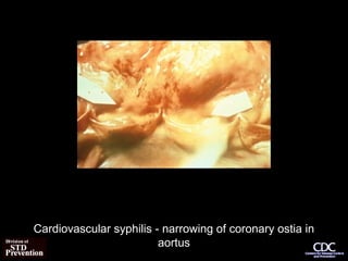 Cardiovascular syphilis - narrowing of coronary ostia in
aortus