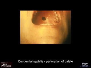 Congenital syphilis - perforation of palate
 
