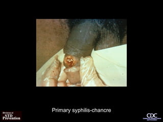 Primary syphilis-chancre
 