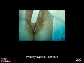 Primary syphilis - chancre
 