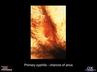 Primary syphilis - chancre of anus