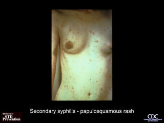 Secondary syphilis - papulosquamous rash
 