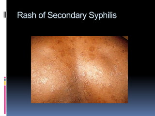 Syphilis 2 .pptx . | PPTX