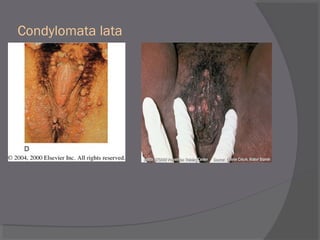 Condylomata lata
 
