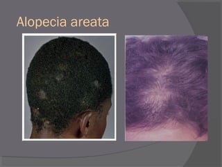 Alopecia areata
 