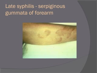 Late syphilis - serpiginous
gummata of forearm
 