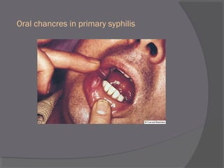 Oral chancres in primary syphilis
 