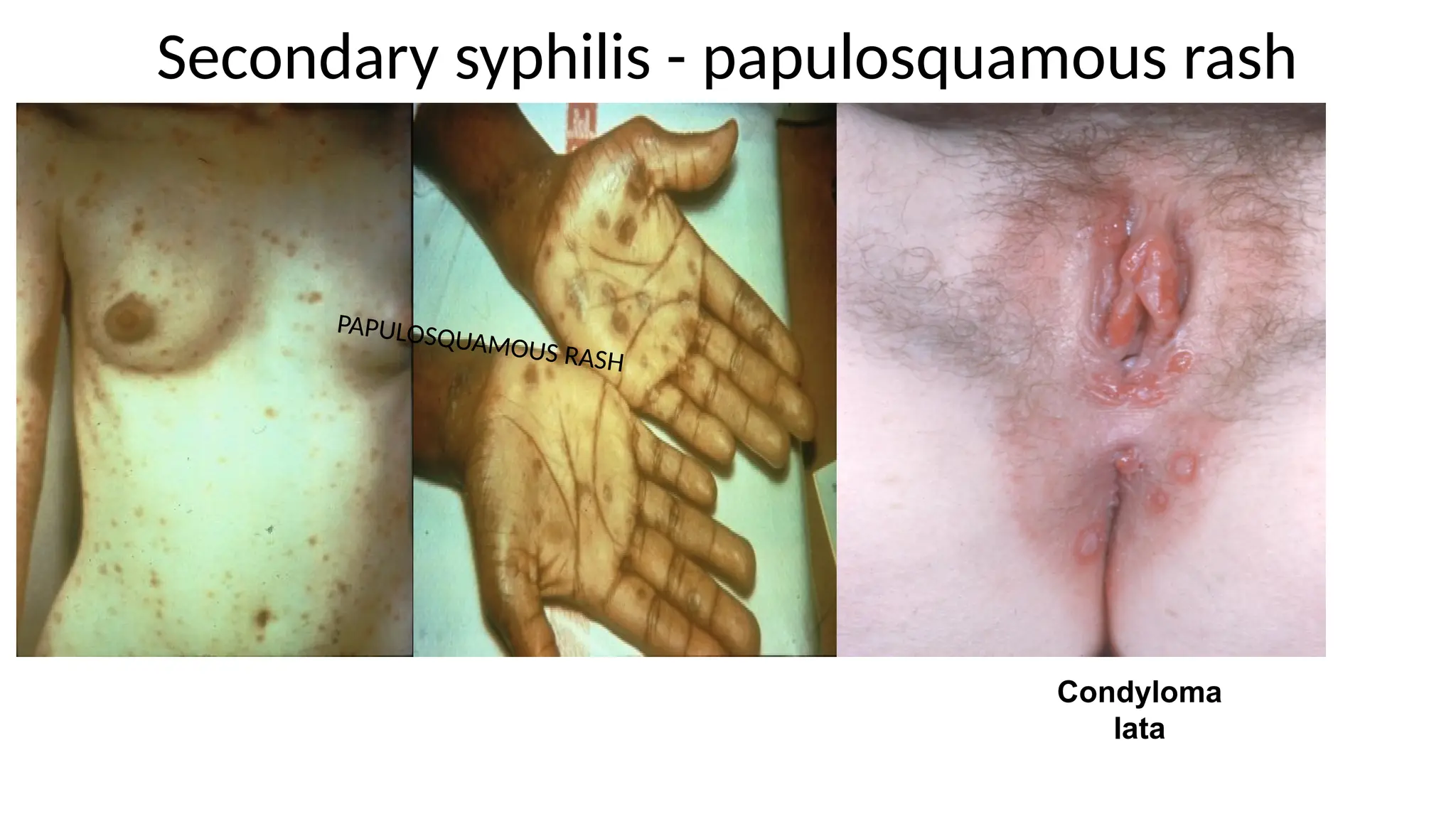 Secondary syphilis - papulosquamous rash
Condyloma
lata
PAPULOSQUAMOUS RASH
 