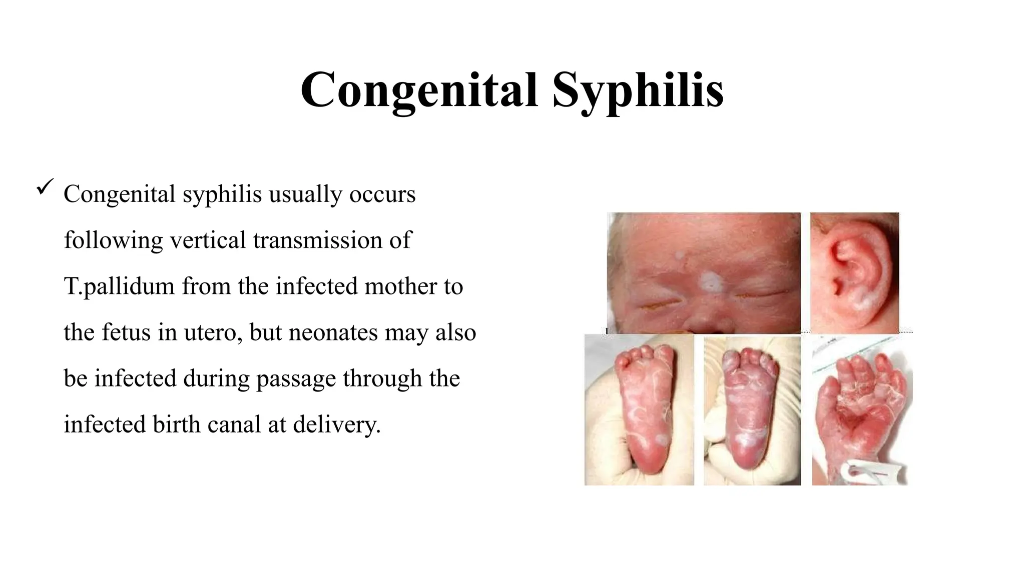 Congenital Syphilis
 Congenital syphilis usually occurs
following vertical transmission of
T.pallidum from the infected mother to
the fetus in utero, but neonates may also
be infected during passage through the
infected birth canal at delivery.
 
