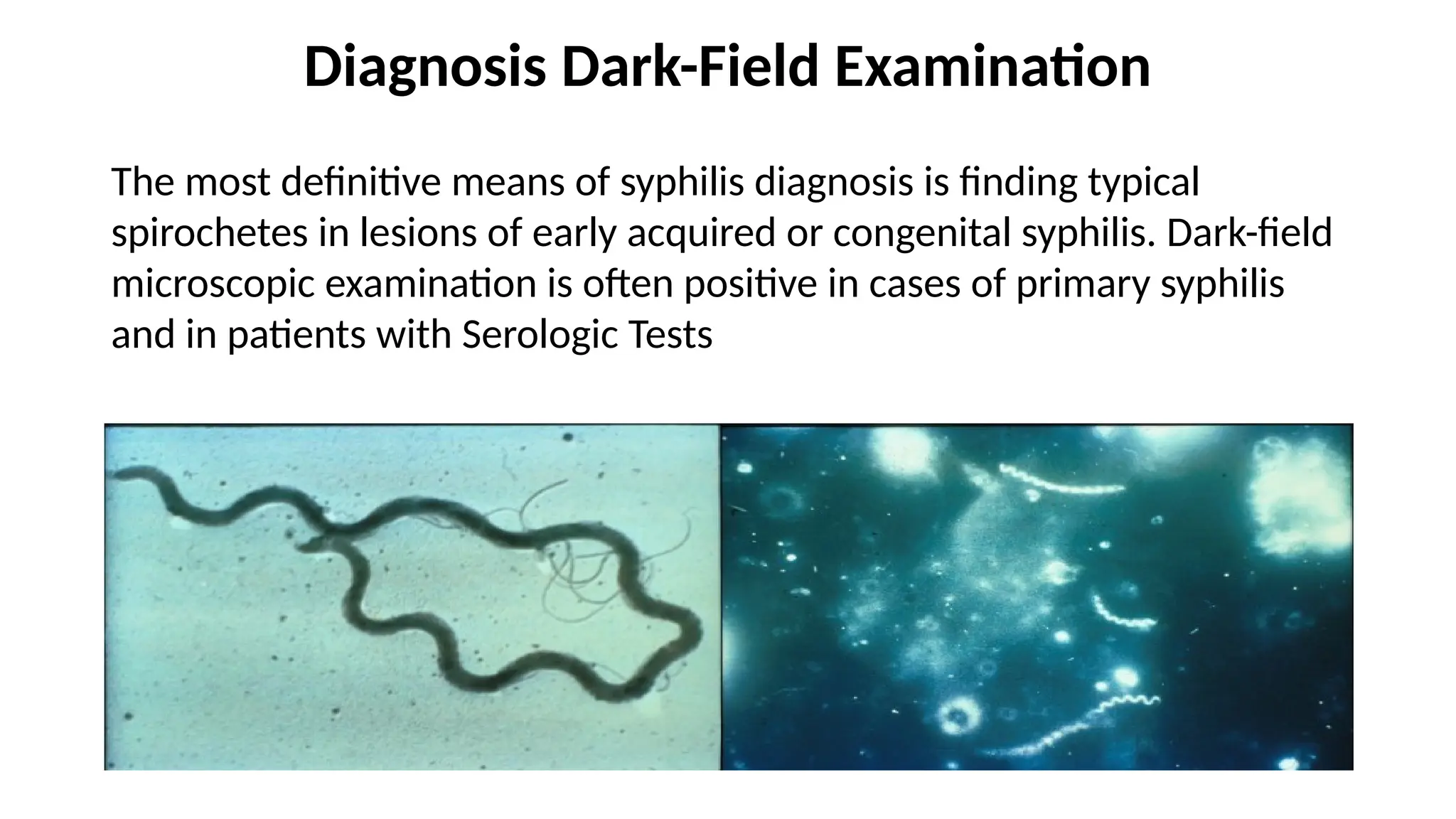 Diagnosis Dark-Field Examination
The most definitive means of syphilis diagnosis is finding typical
spirochetes in lesions of early acquired or congenital syphilis. Dark-field
microscopic examination is often positive in cases of primary syphilis
and in patients with Serologic Tests
 