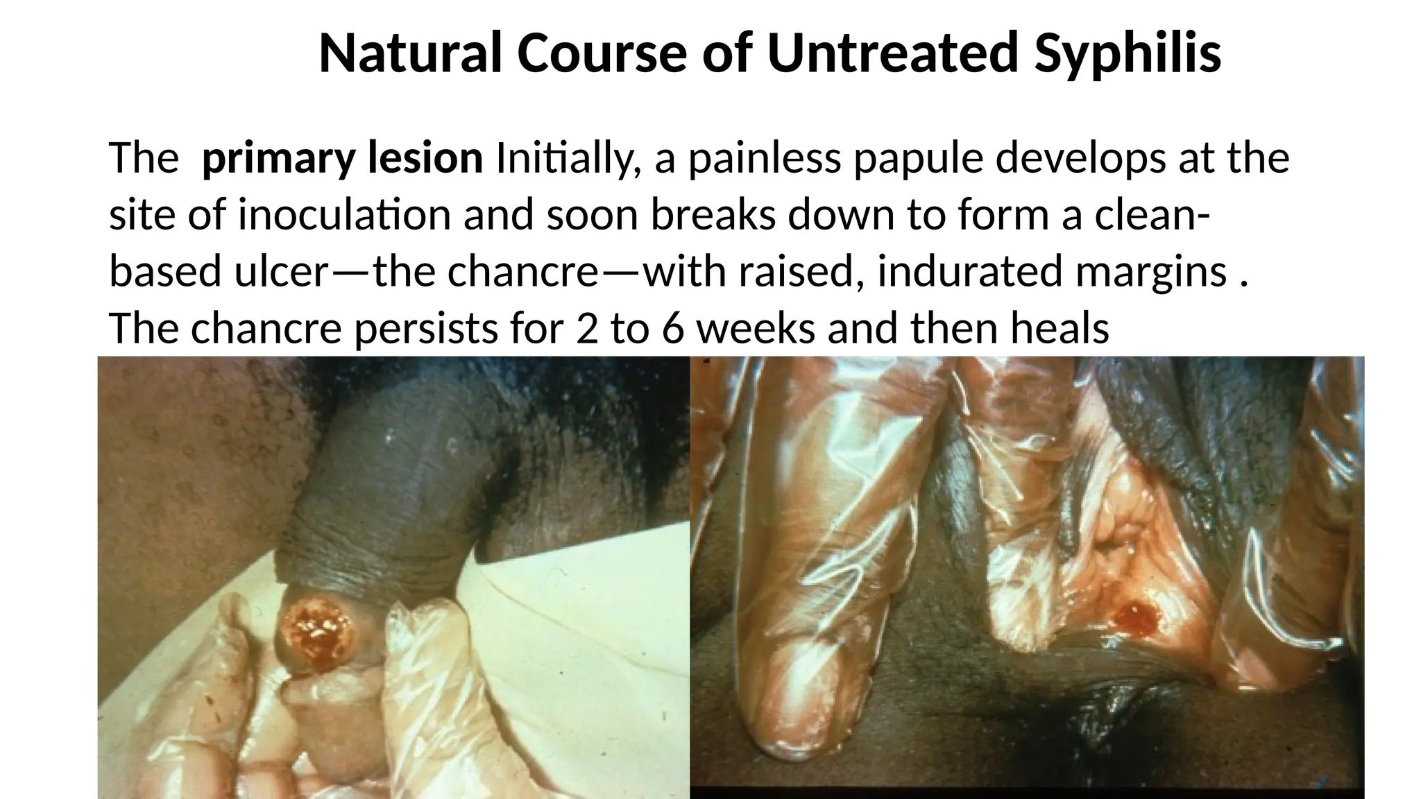 Natural Course of Untreated Syphilis
The primary lesion Initially, a painless papule develops at the
site of inoculation and soon breaks down to form a clean-
based ulcer—the chancre—with raised, indurated margins .
The chancre persists for 2 to 6 weeks and then heals
spontaneously.
 