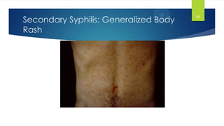 Syphilis by m yousry for undergraduates | PPSX