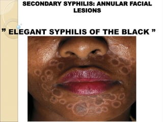 SYPHILIS CONFERENCE medical students.ppt