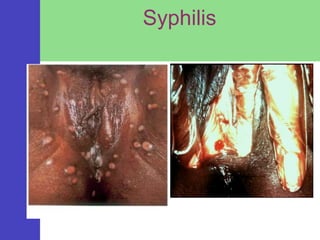Syphilis
 