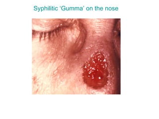 Syphilitic ‘Gumma’ on the nose
 