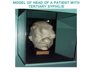 MODEL OF HEAD OF A PATIENT WITH
TERTIARY SYPHILIS
 