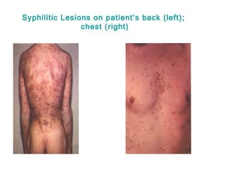Syphilitic Lesions on patient’s back (left);
chest (right)
 