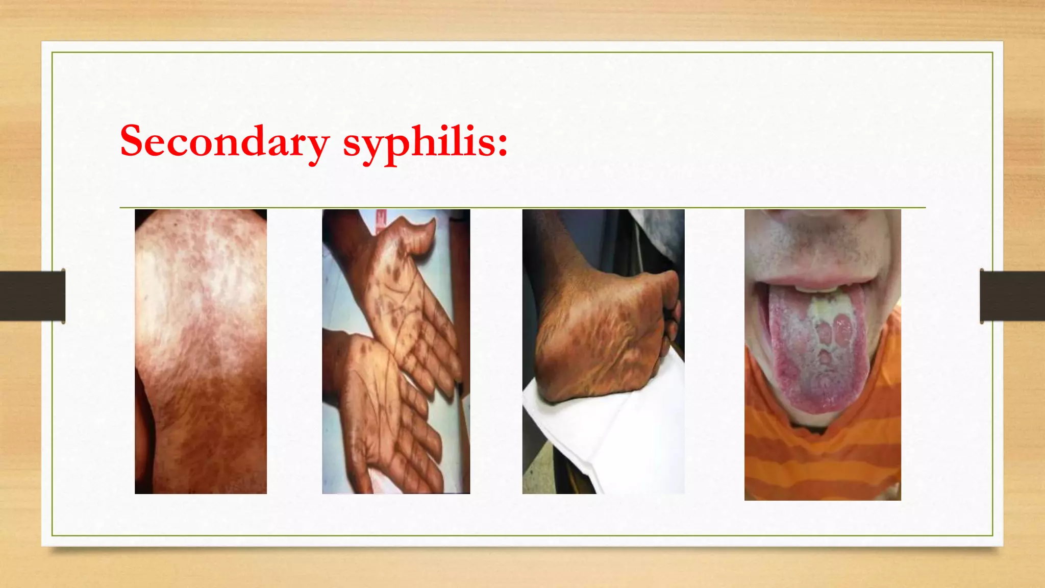 Secondary syphilis:
 