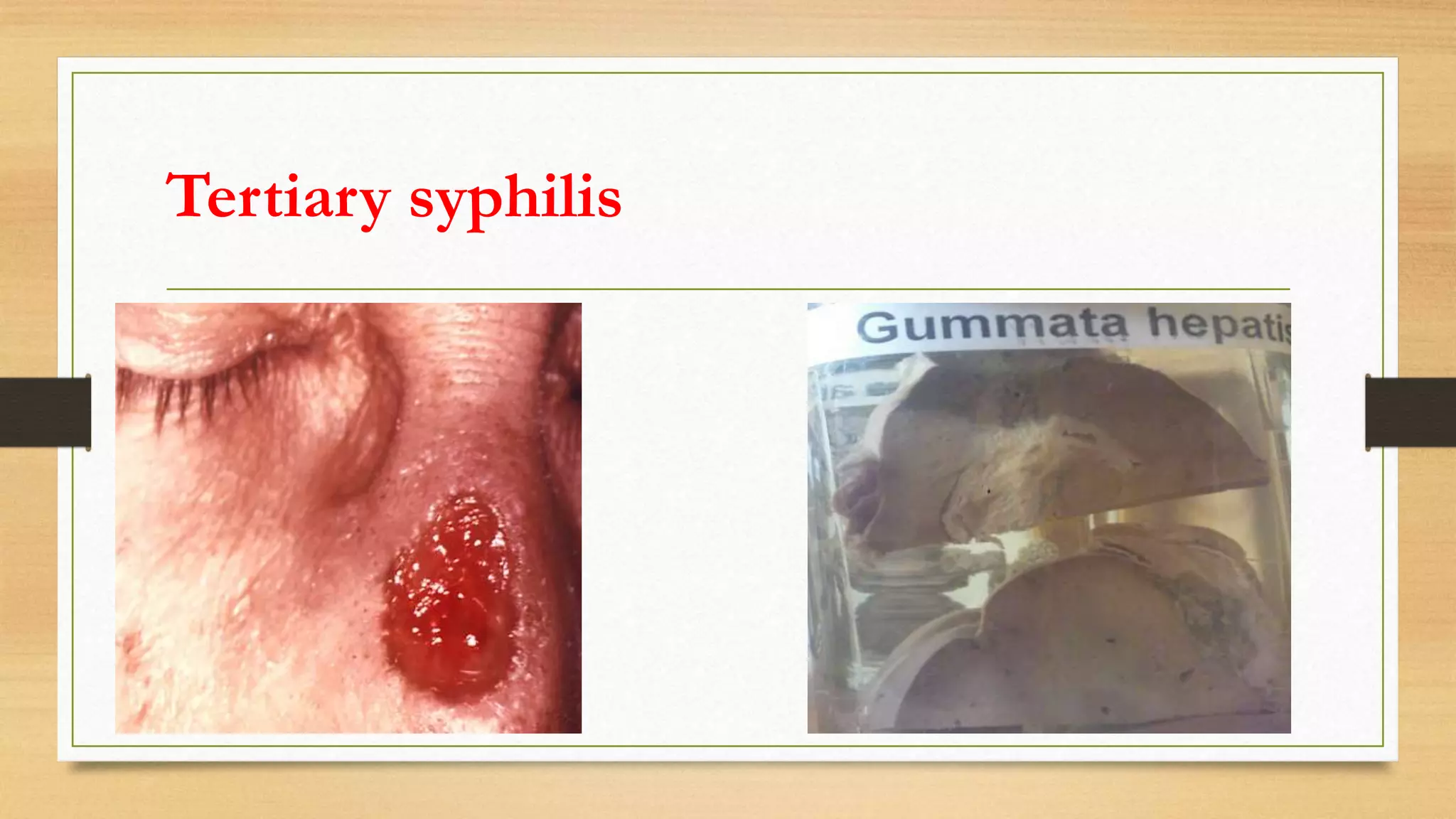 Tertiary syphilis
 