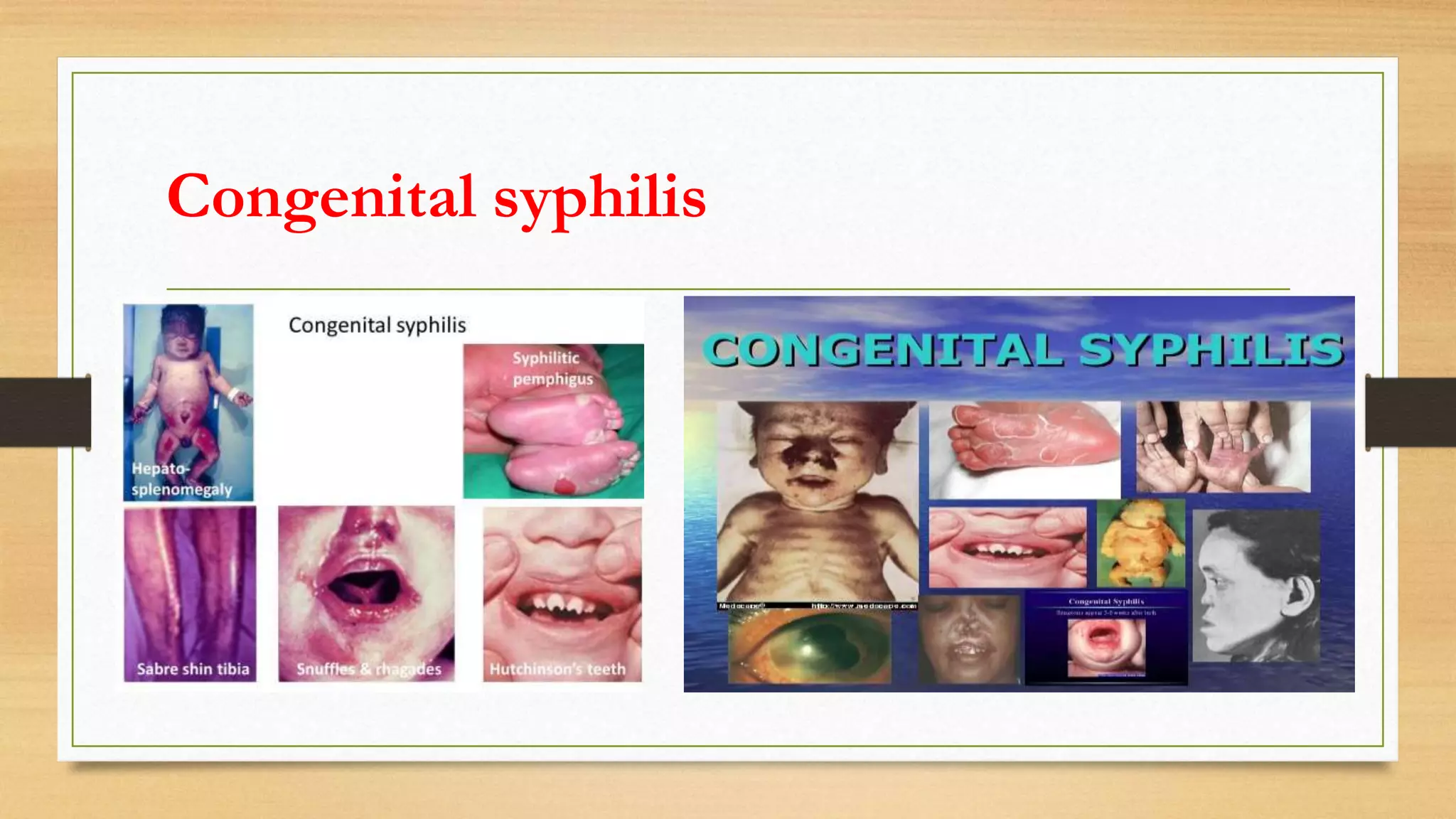 Congenital syphilis
 