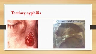 Tertiary syphilis
 