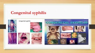 Congenital syphilis
 