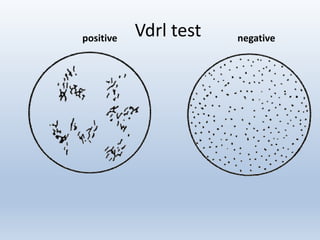 Vdrl testpositive negative
 