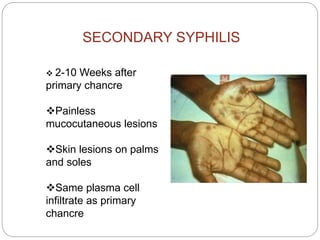 Other manifestations of
secondary syphilis
- lymphadenopathy,Rashes,
-Malaise, fever,weight loss
- Alopecia
- Neurosyphil...