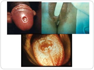 SECONDARY SYPHILIS
 Condylomata lata – broad based elevated
plaques
- in moist areas of skin
 