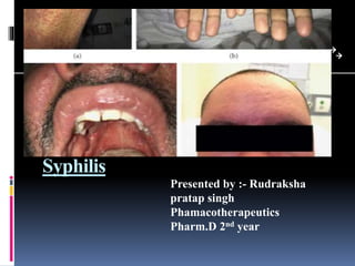 Syphilis
Presented by :- Rudraksha
pratap singh
Phamacotherapeutics
Pharm.D 2nd year
 