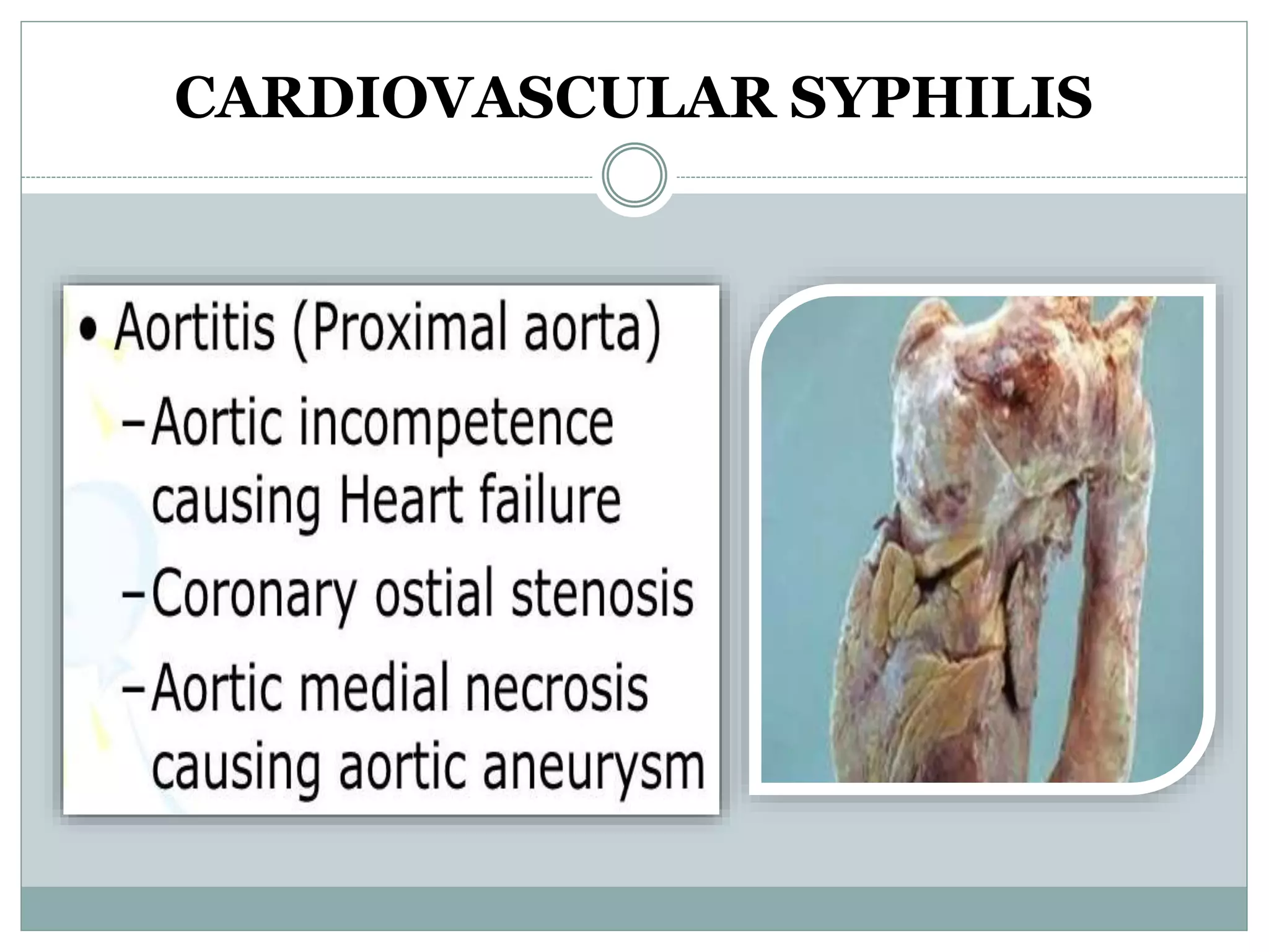 Syphilis | PPTX