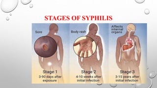 Syphilis | PPTX