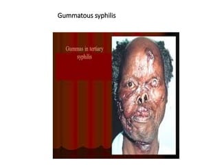 Gummatous syphilis
 