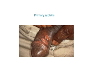 Primary syphilis
 